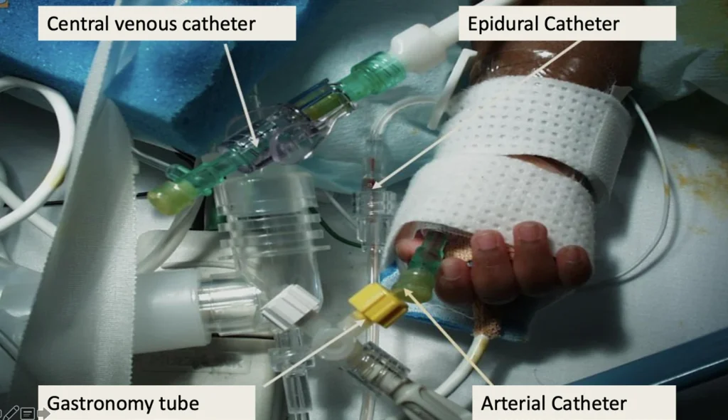 Exemple clinice cu conectori intravenoși, epidurali, enterali și arteriali la un pacient ATI