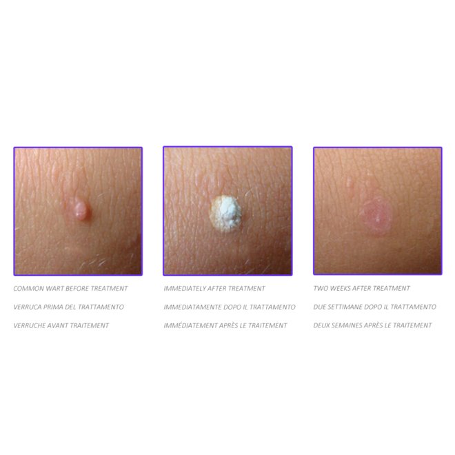 Dispozitiv Criochirurgical Cryomega – Precizie Criogenică cu Cartuș de 16 g